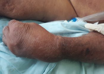 Paciente ‘devorado’ por formigas em UTI do Socorrão II vai a óbito