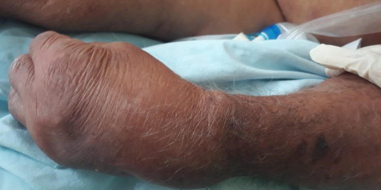 Paciente ‘devorado’ por formigas em UTI do Socorrão II vai a óbito